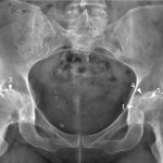 Osteoarthritis of the hips